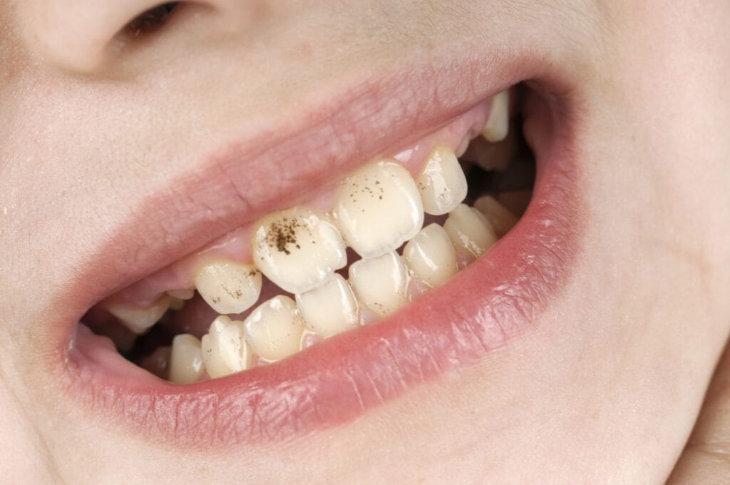 woman smiling with plaque on her teeth showing