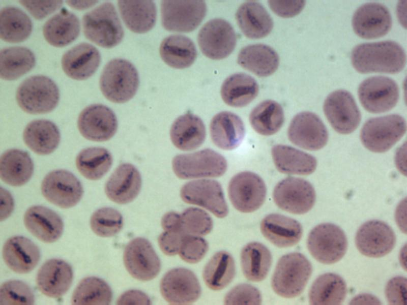 Evan's 2023 thin blood smear slide, showing asymptomatic malaria parasites, and some misshapen blood cells.