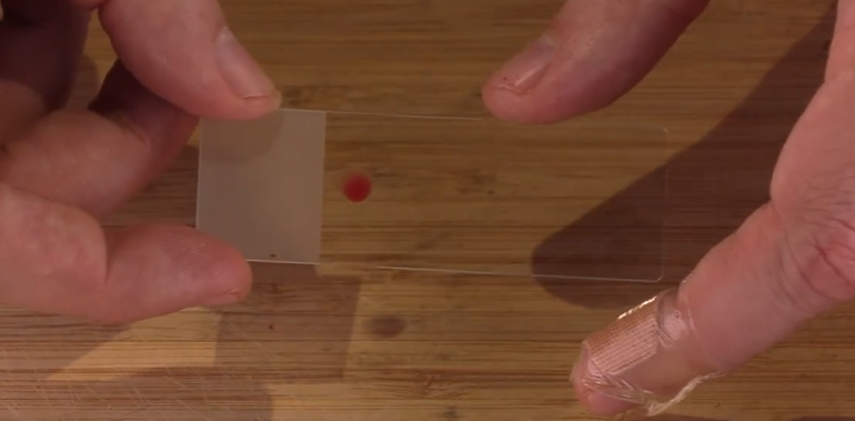 Evan collecting a drop of blood to put onto a slide for thin film blood parasite analysis